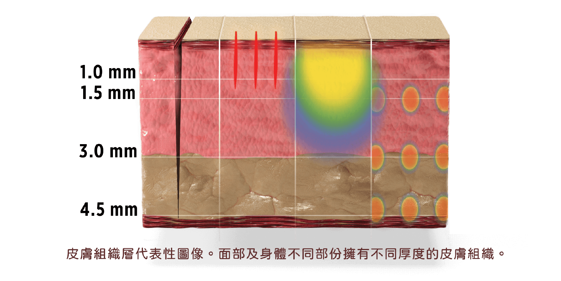 ultherapy web-08 5大功效