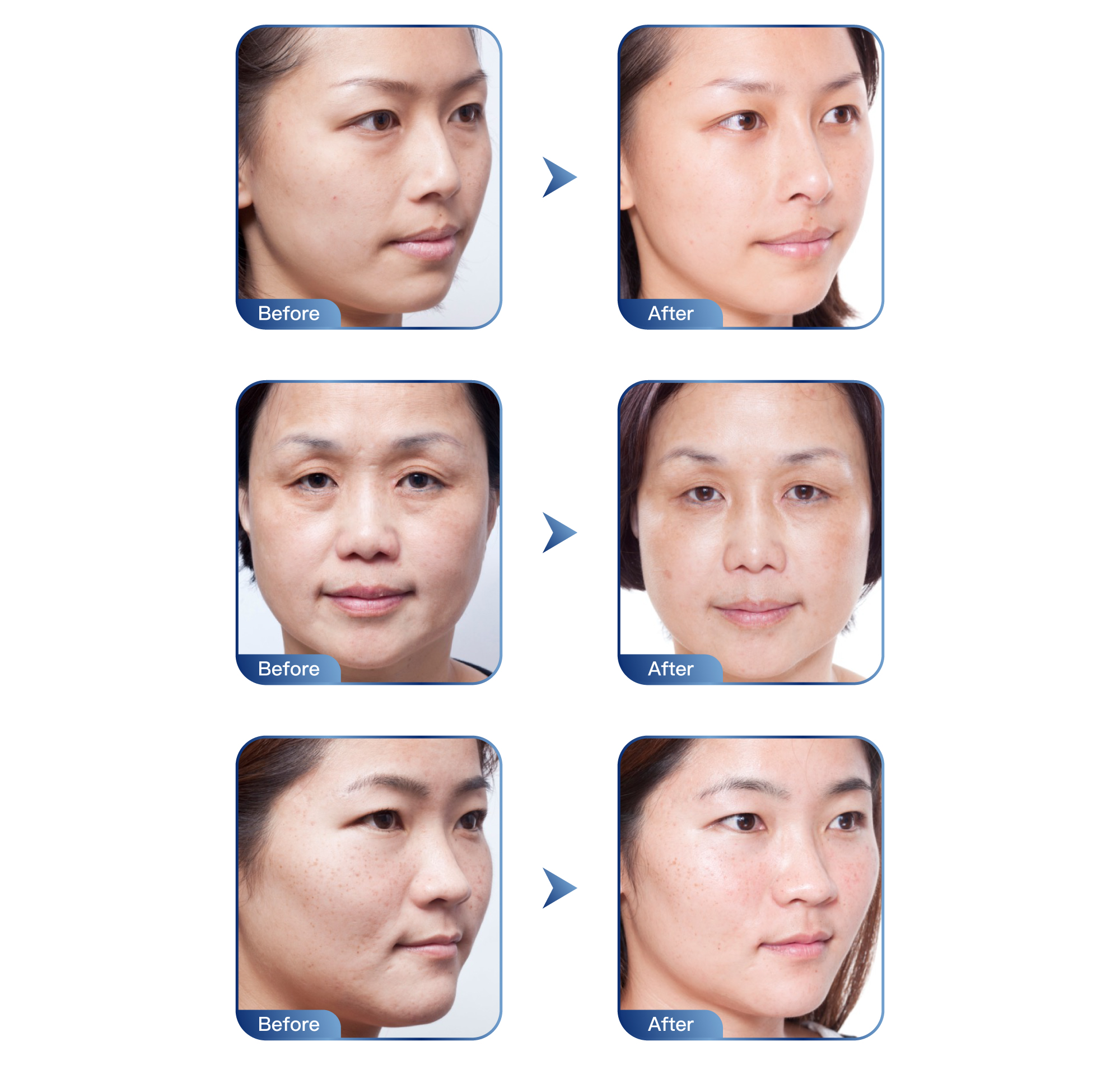 Restylane skin booster Vital Light_web 3 aging3